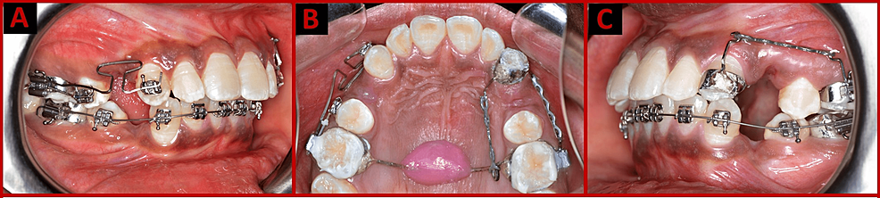 PDF) Clinical application of group B T-loop spring for retraction