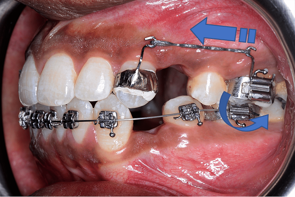 Comparison of Maxillary Canine Retraction Using SplitMouth Design With