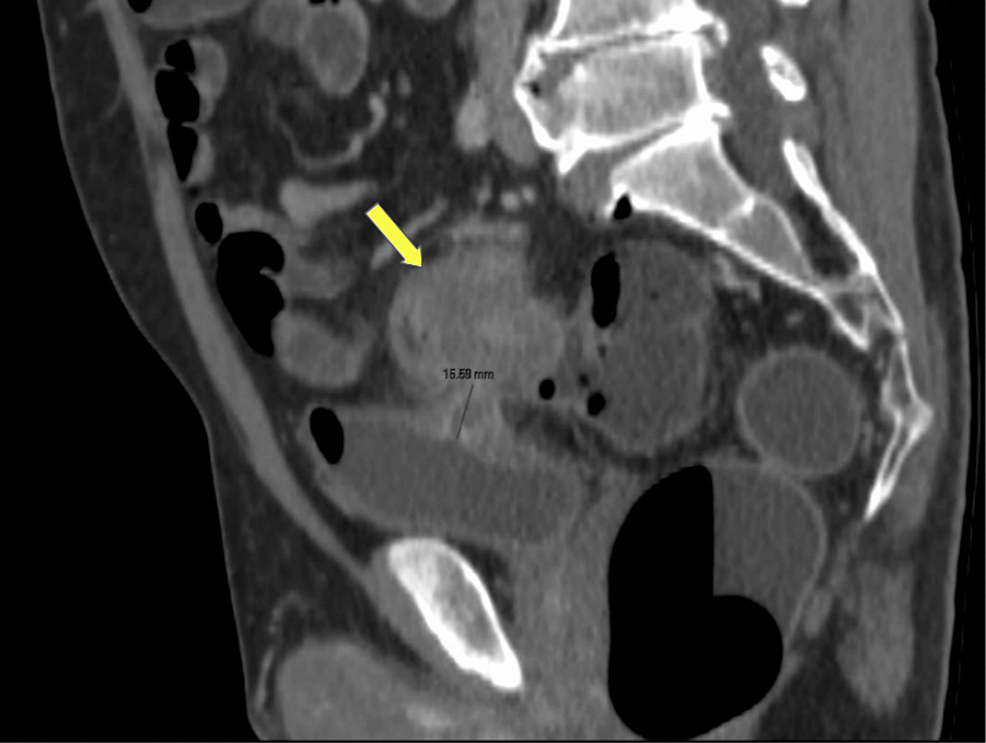 cureus-syndrome-of-inappropriate-antidiuresis-due-to-chronic