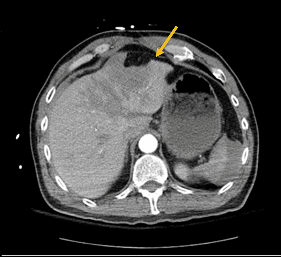 Cureus Grade V Liver Injury Presented With Peritonitis Treated With StaplerAssisted Hepatic