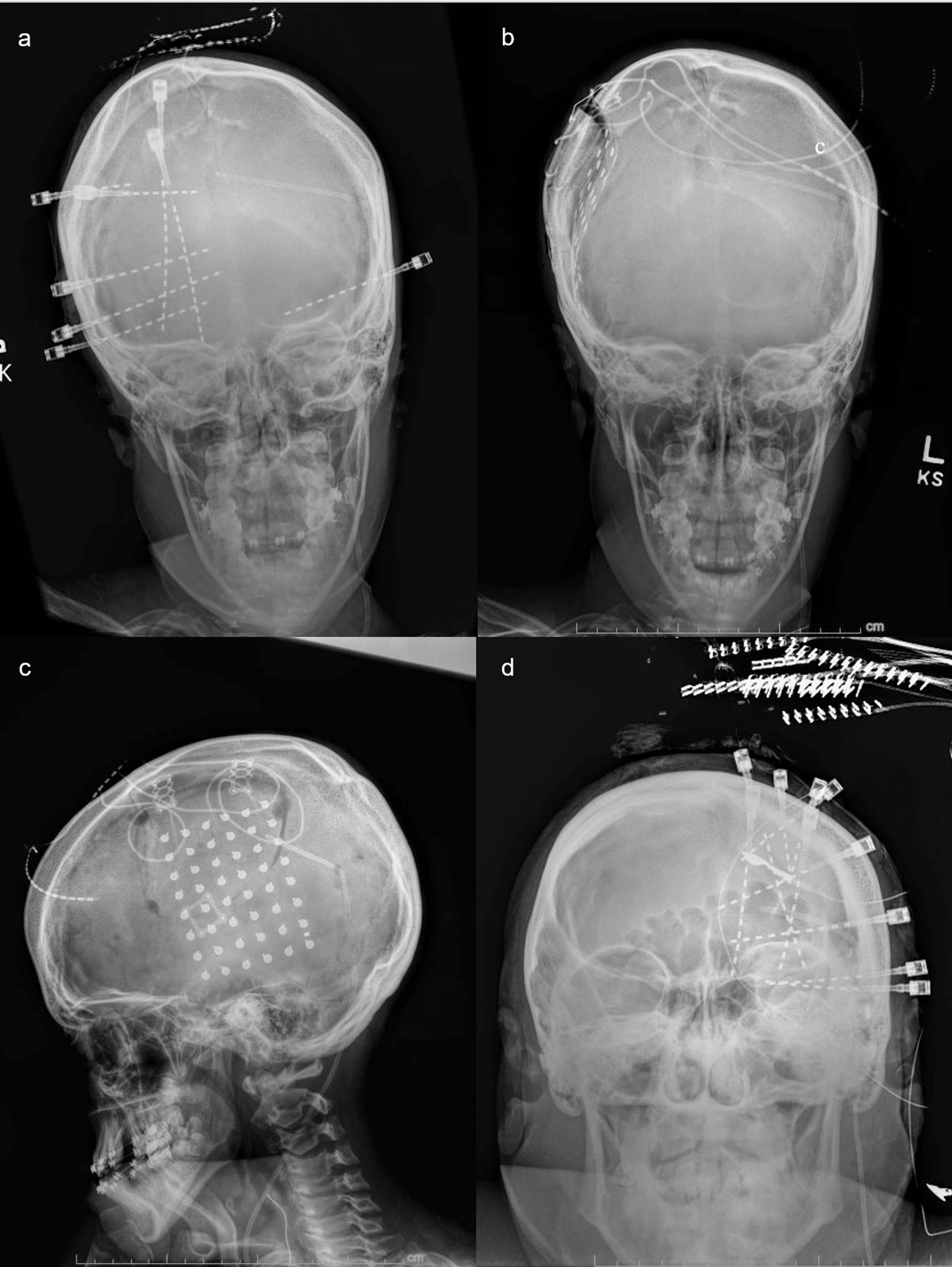 Cureus Invasive Intracranial Electroencephalogram (EEG) Monitoring