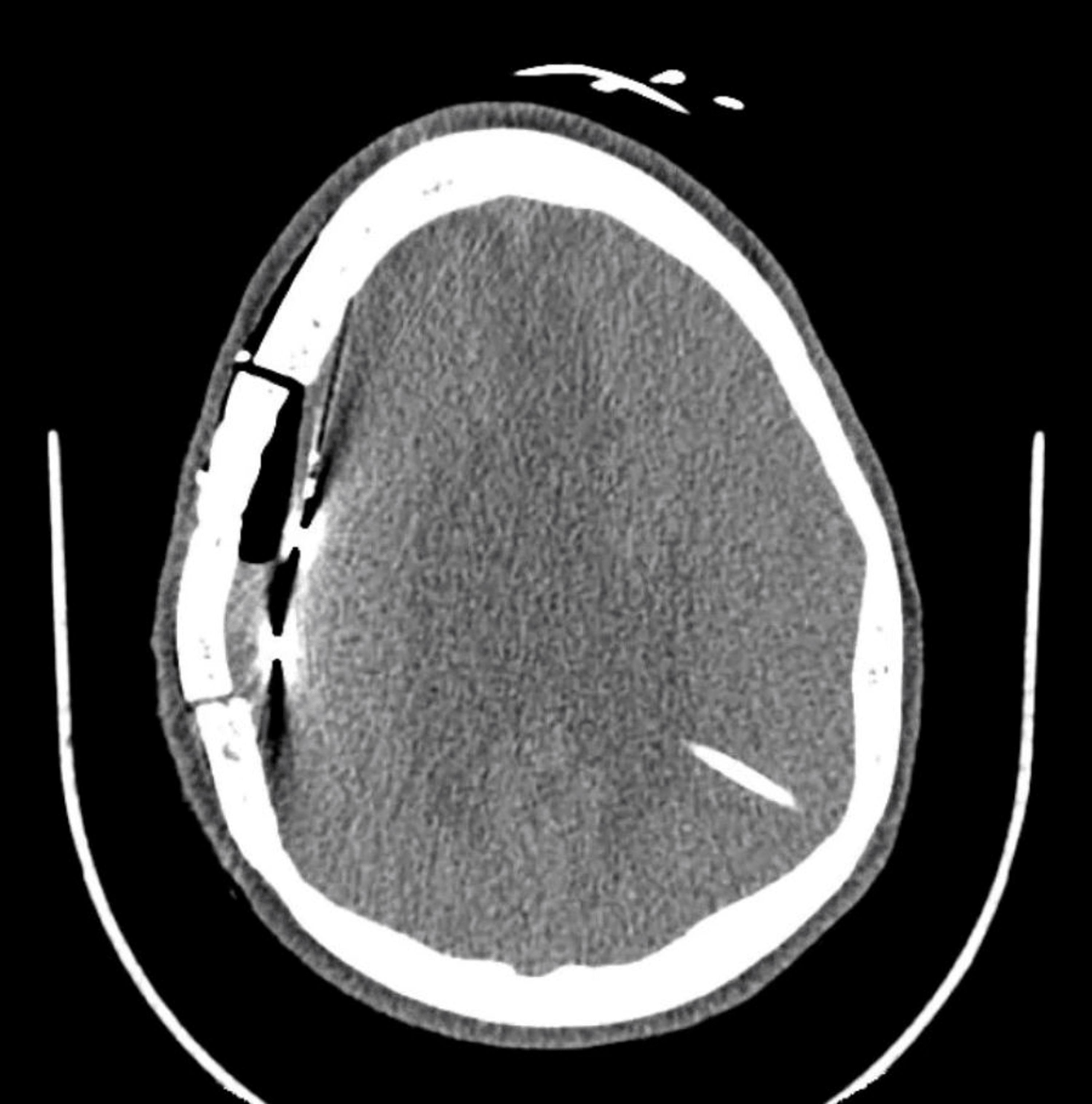 Cureus Invasive Intracranial Electroencephalogram (EEG) Monitoring for Epilepsy in the