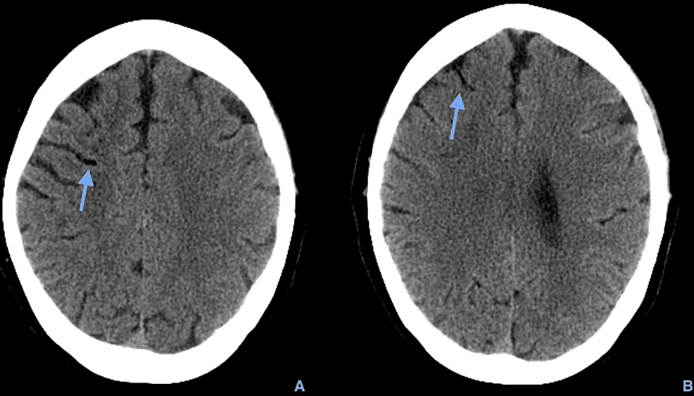 Cureus | A Case of Cerebral Air Embolism After Dental Procedure