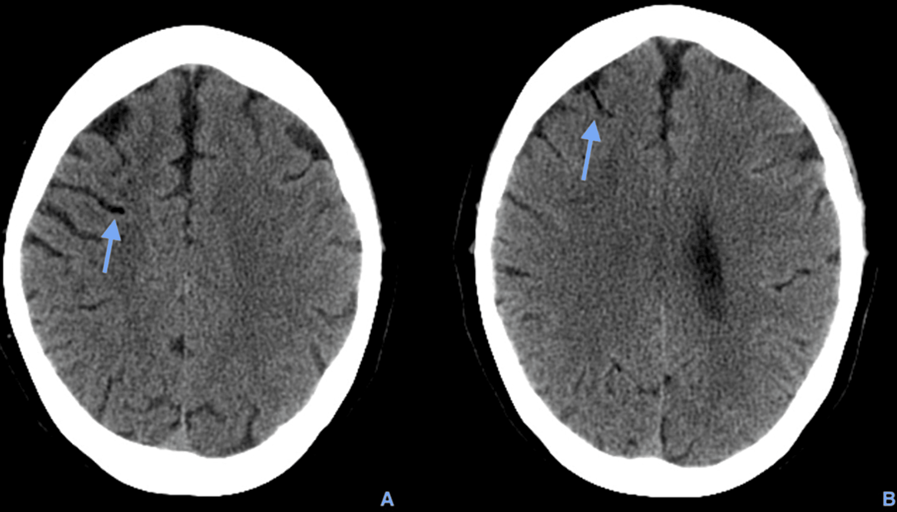 Cureus A Case of Cerebral Air Embolism After Dental Procedure