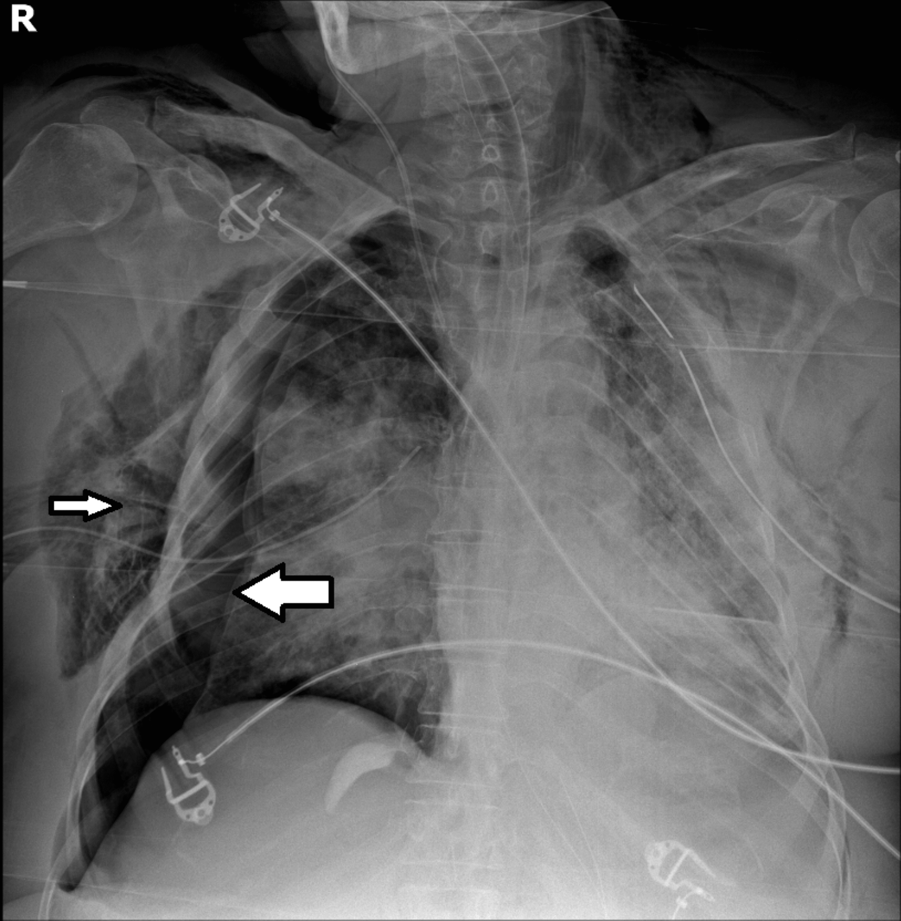 Cureus Disseminated Intravascular Coagulation in COVID19 Setting A