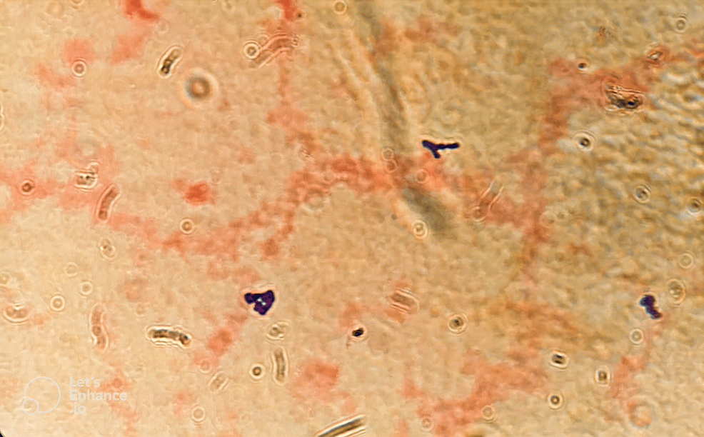 Septic Abortion Secondary to Peptoniphilus asaccharolyticus Complicated