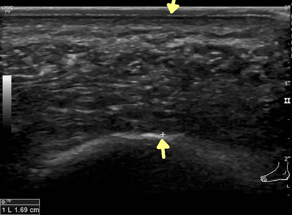 Sonographic Evaluation of the Plantar Heel in Asymptomatic Endurance Runners