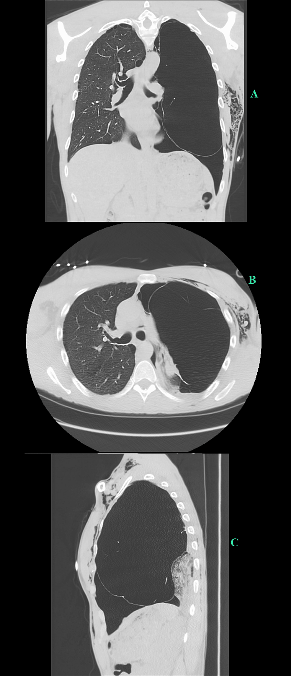 Cardiothoracic Surgery Management Of Giant Bullous Lung Disease ...