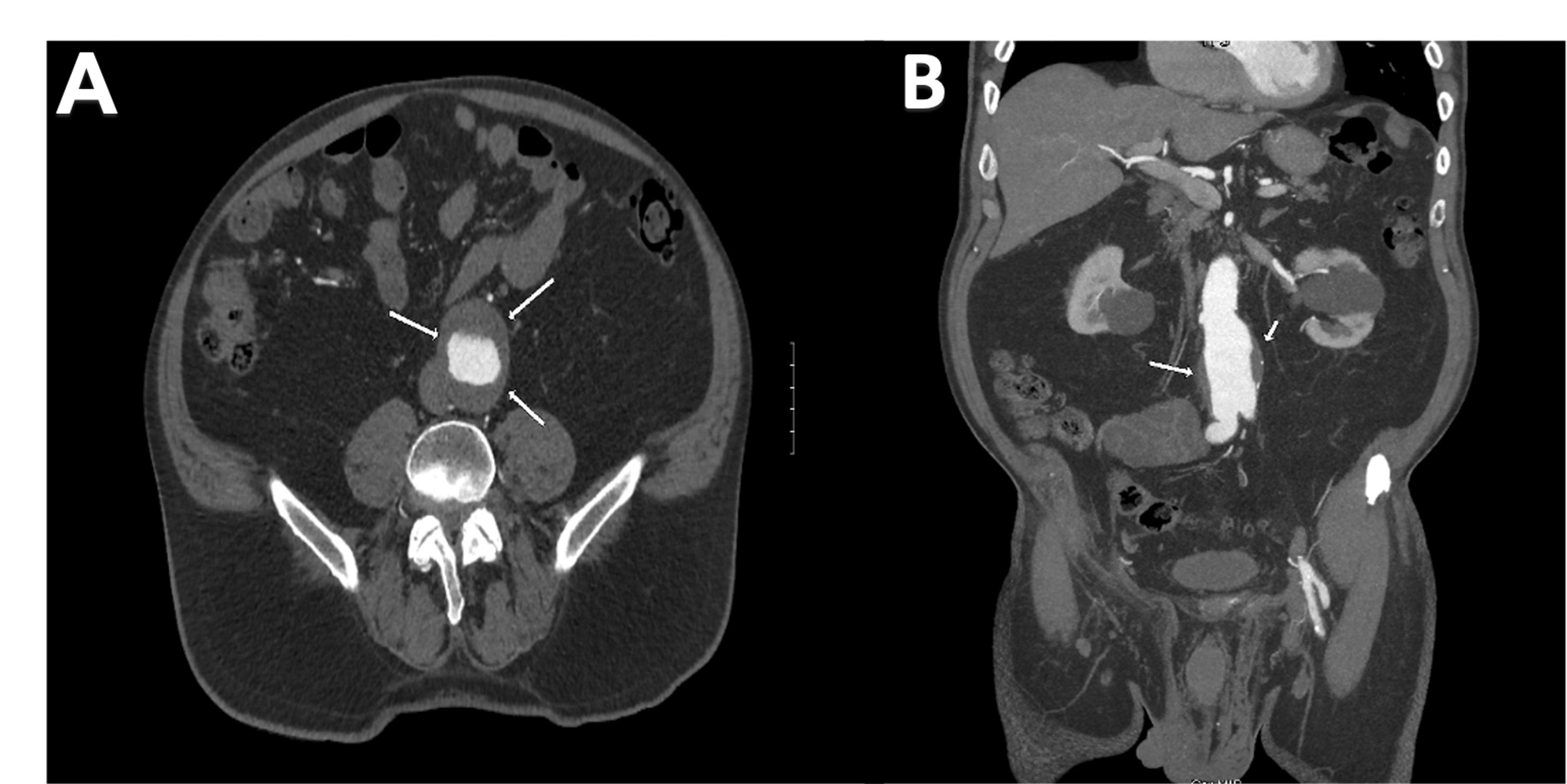 Spinal Cord Ischemia Following Endovascular Abdominal Aortic Aneurysm ...