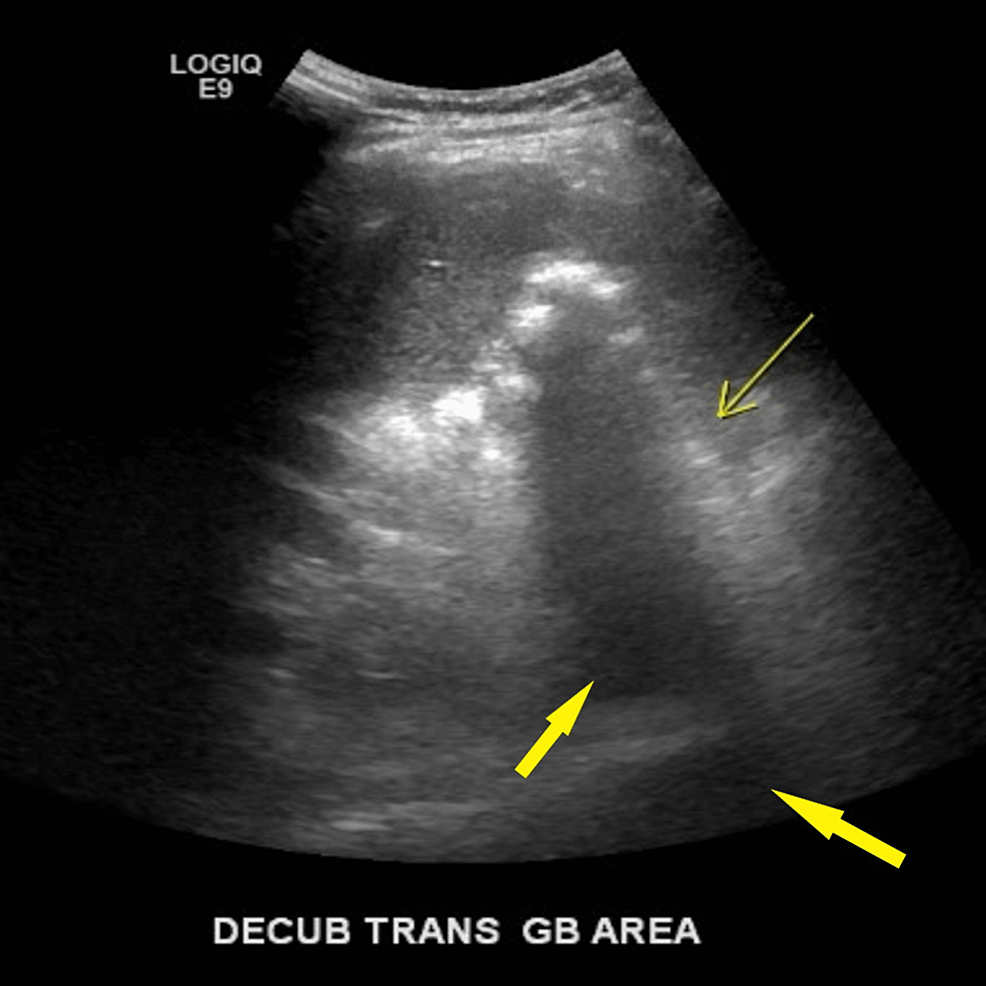 Cureus A Unique Case of Gallbladder Agenesis and Cholangiocarcinoma