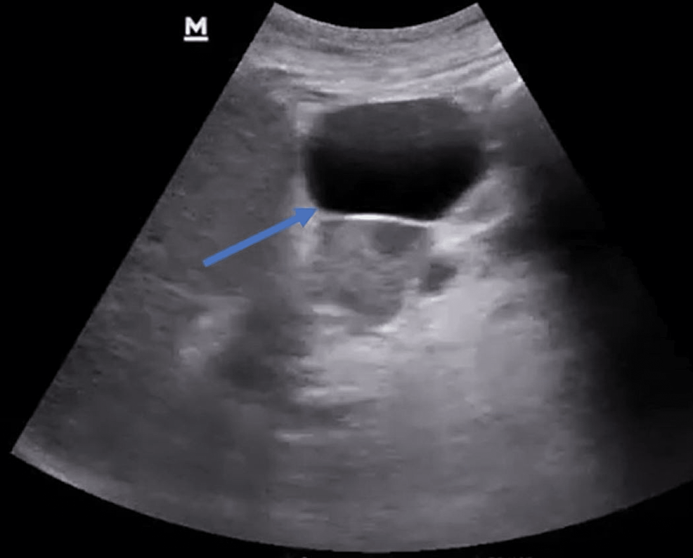 lesser sac ultrasound