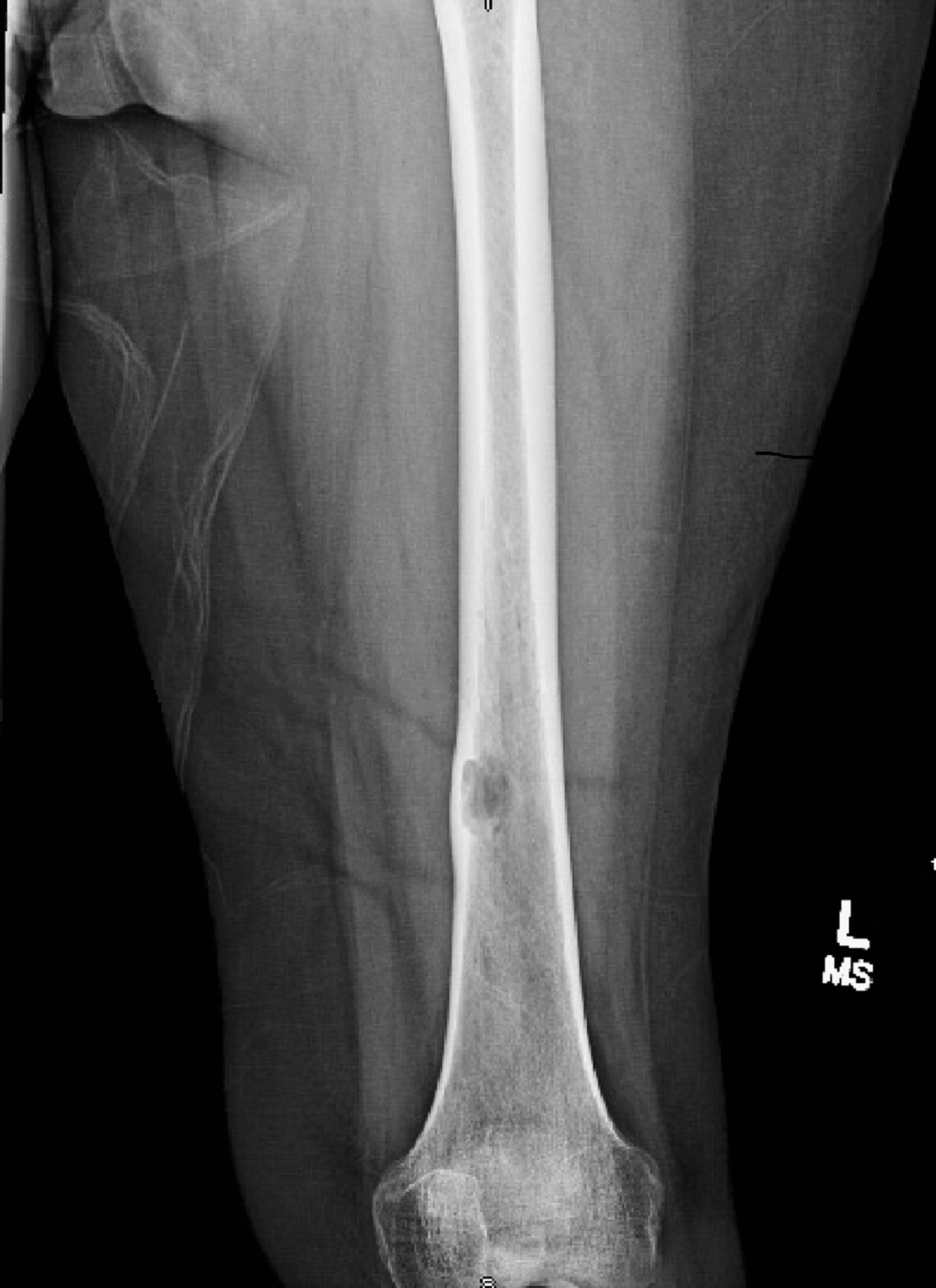 Cureus Total Hip Arthroplasty With Prophylactic Fixation of Greater