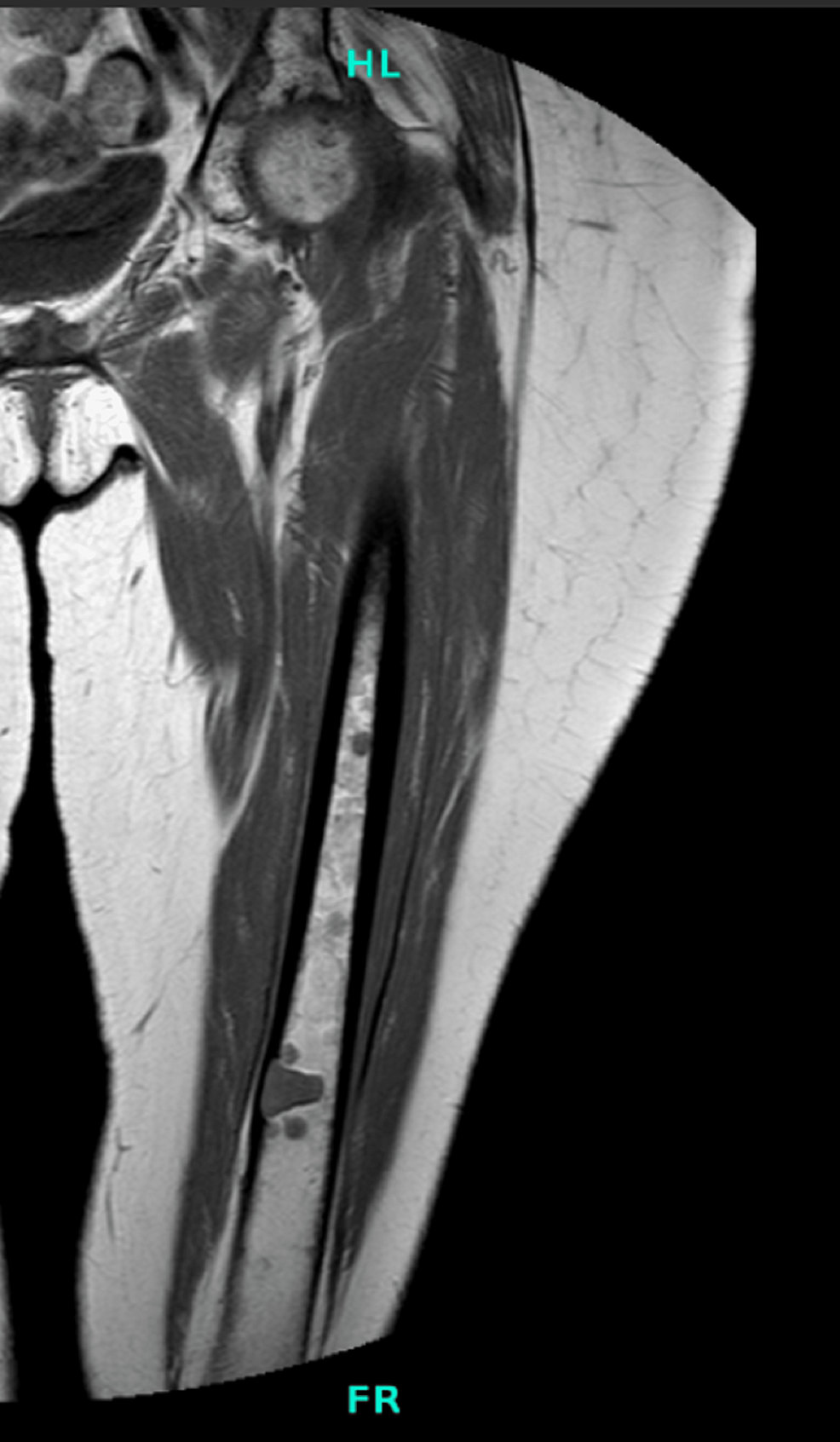 Cureus Total Hip Arthroplasty With Prophylactic Fixation of Greater Trochanter and Distal