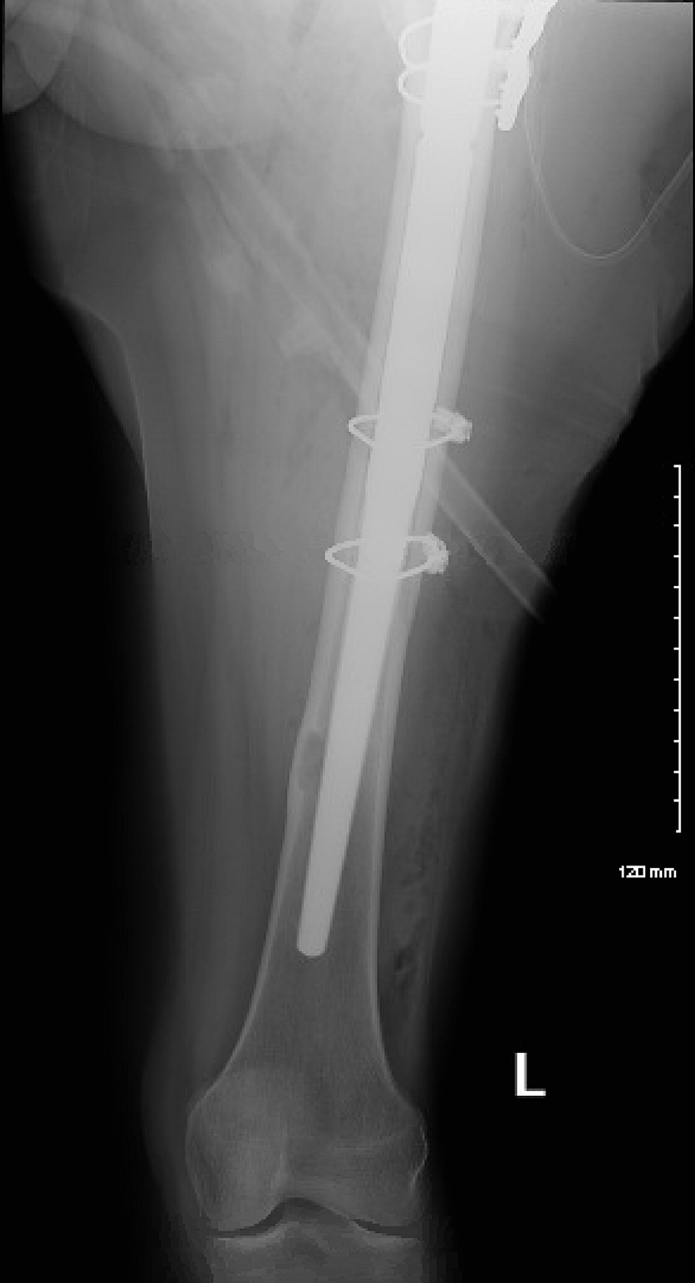 Cureus Total Hip Arthroplasty With Prophylactic Fixation of Greater Trochanter and Distal