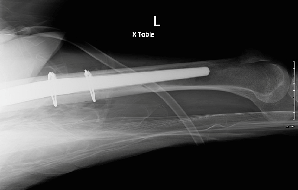Cureus Total Hip Arthroplasty With Prophylactic Fixation of Greater Trochanter and Distal
