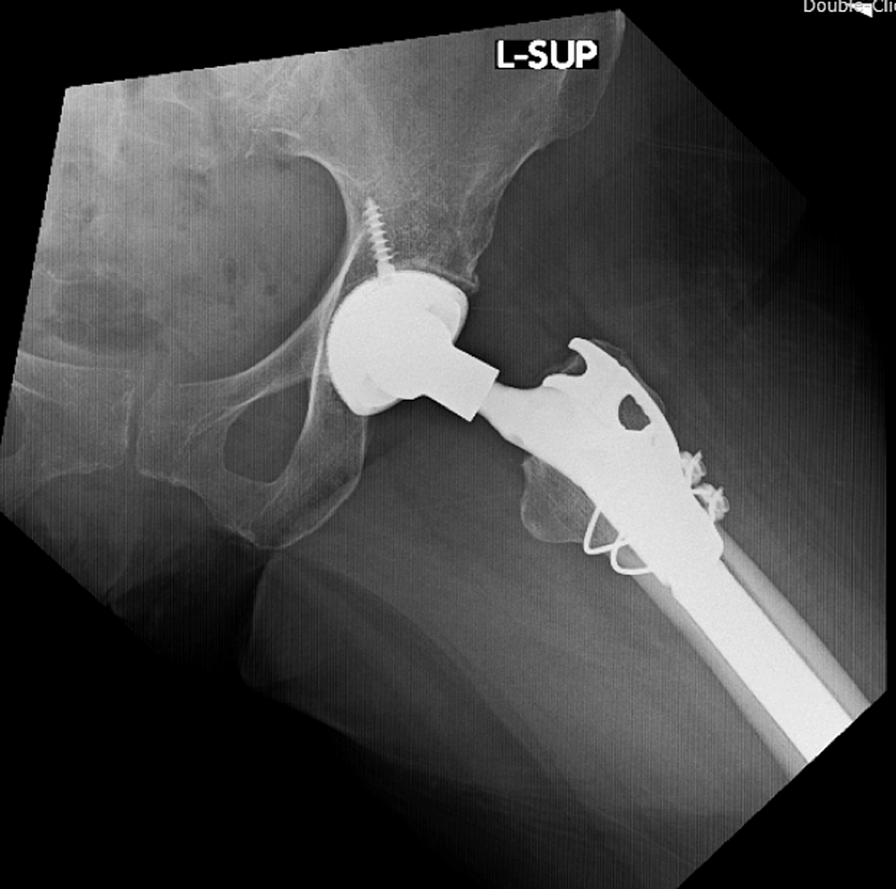 Cureus Total Hip Arthroplasty With Prophylactic Fixation of Greater Trochanter and Distal