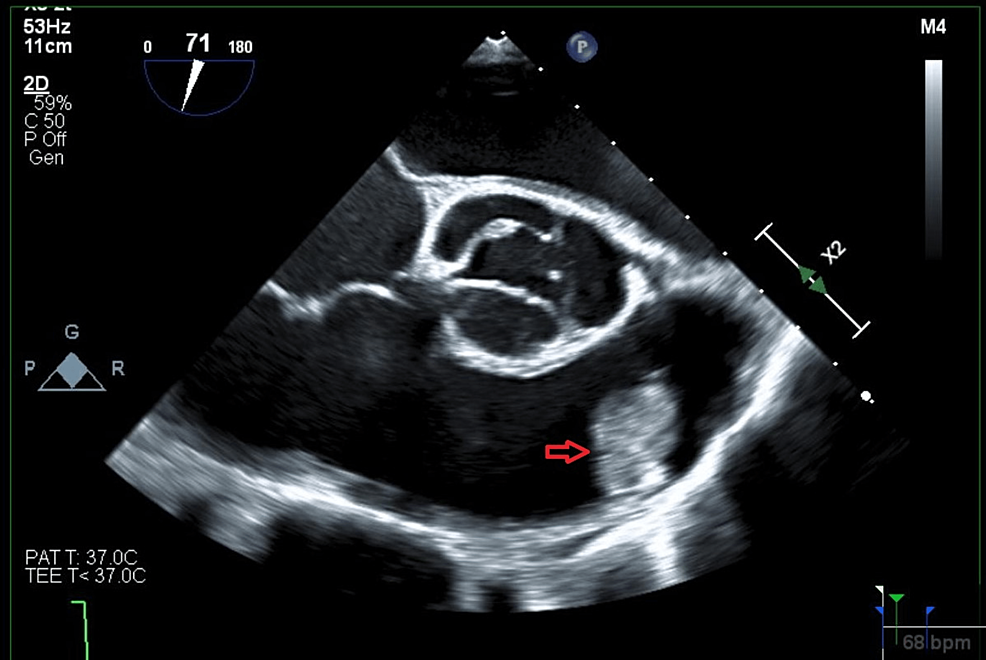 Transthoracic echocardiogram at admission and 6 mo follow up: global