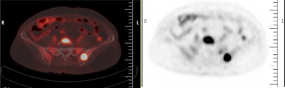 The Diagnostic Accuracy Of Bone Marrow Biopsy Versus PET/CT Scan In ...