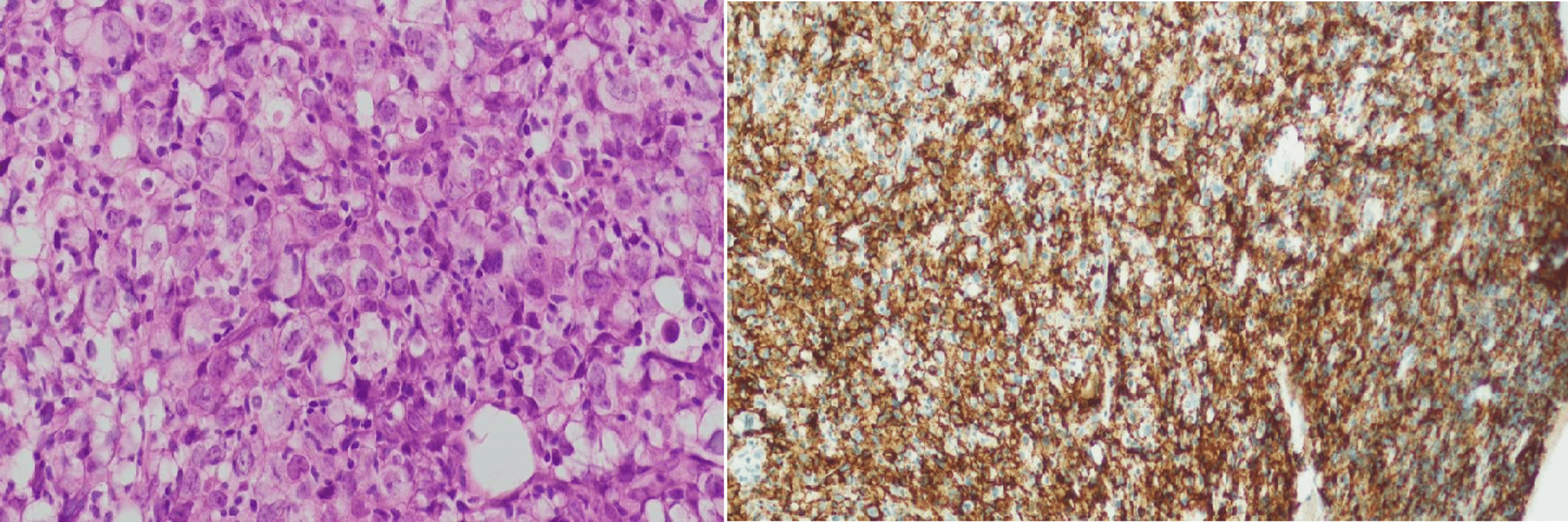 The Diagnostic Accuracy of Bone Marrow Biopsy Versus PET/CT Scan in