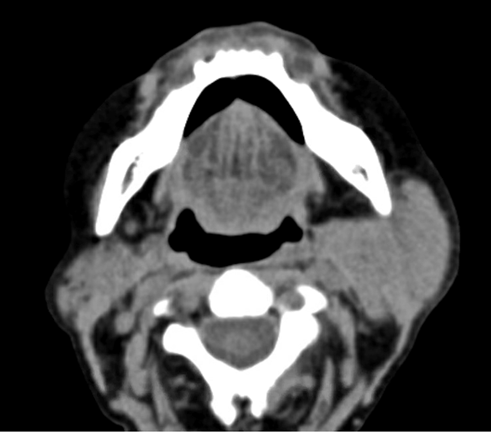 Cureus | A Case Report of Nearly Missed Renal Tubular Acidosis in