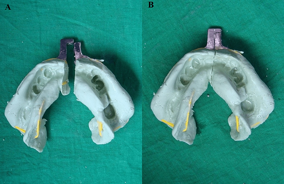 Cureus Sectional Impression Tray With Reusable Handle A Single Solution for All Microstomia Cases