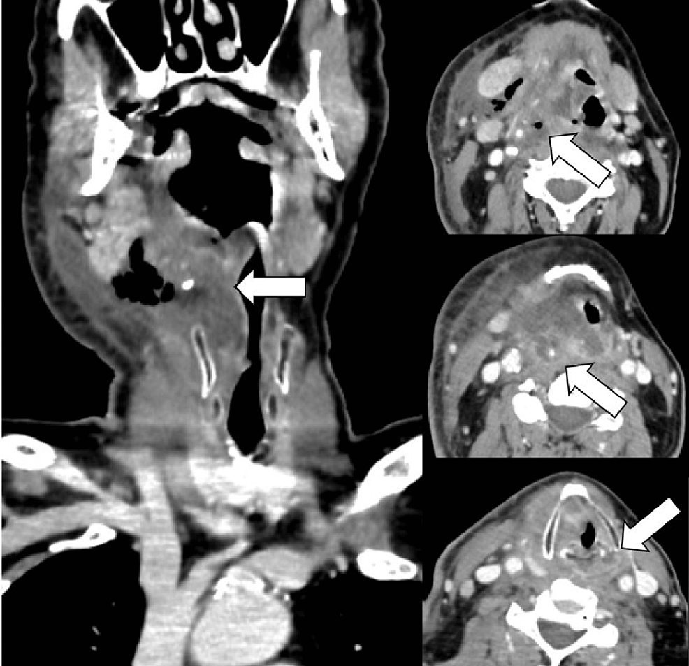 A Simple Antibacterial Treatment Solves a Severe Skin Problem Caused by Radiation  Therapy, Newsroom