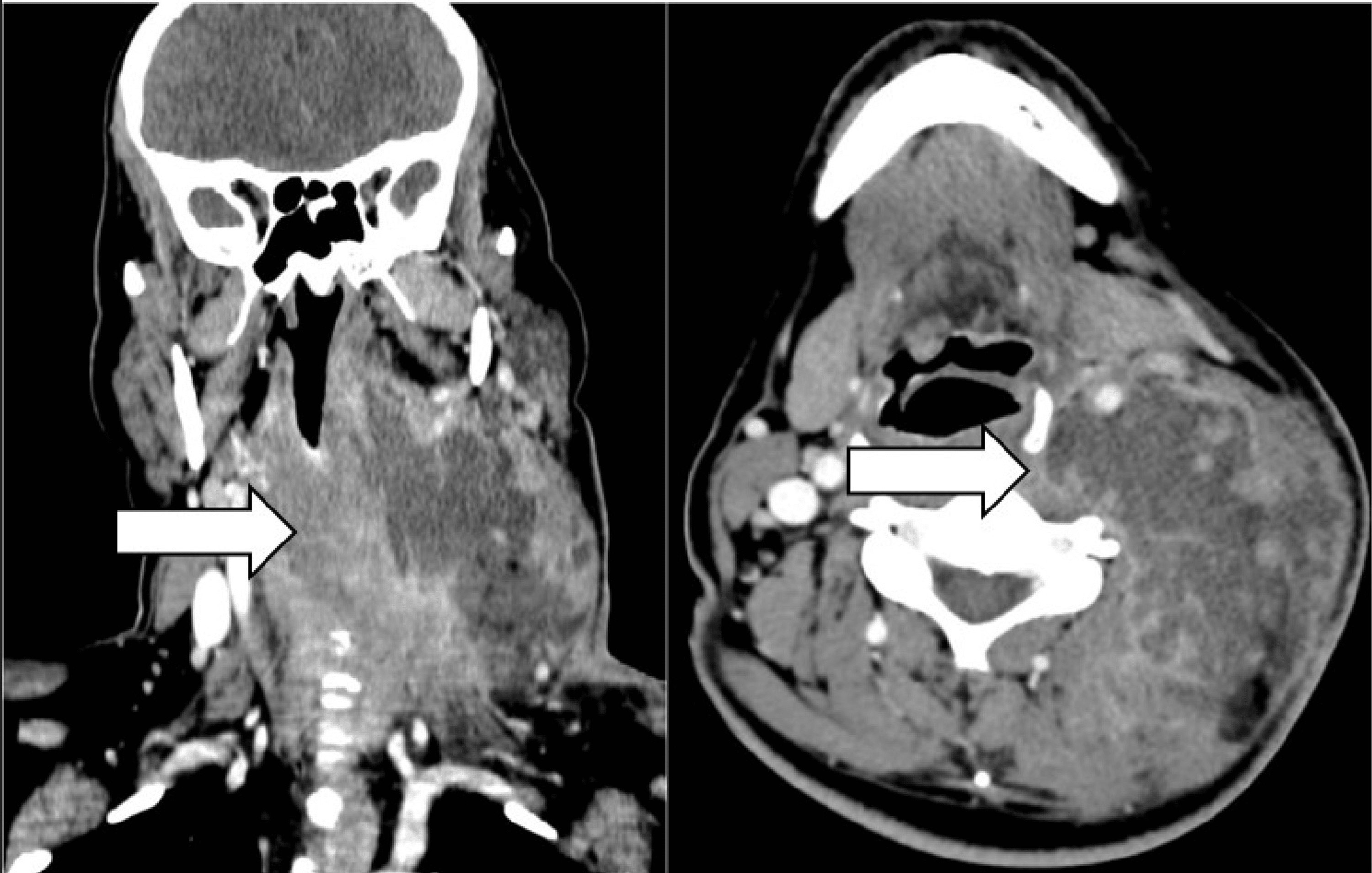 Management Of Deep Neck Space Infections: A Large Tertiary Center ...