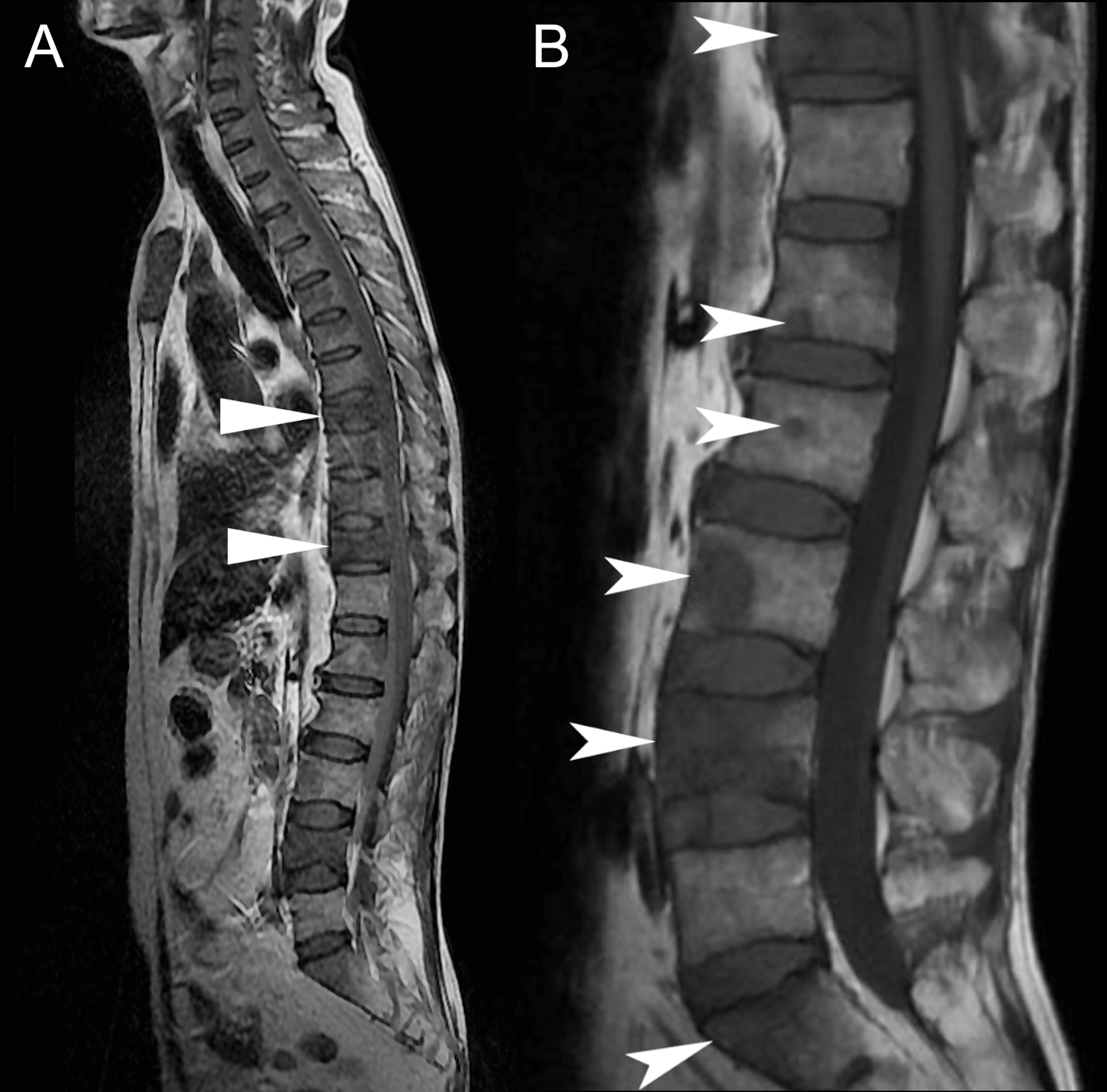 cureus-lung-cancer-with-vertebral-metastases-presenting-as-low-back