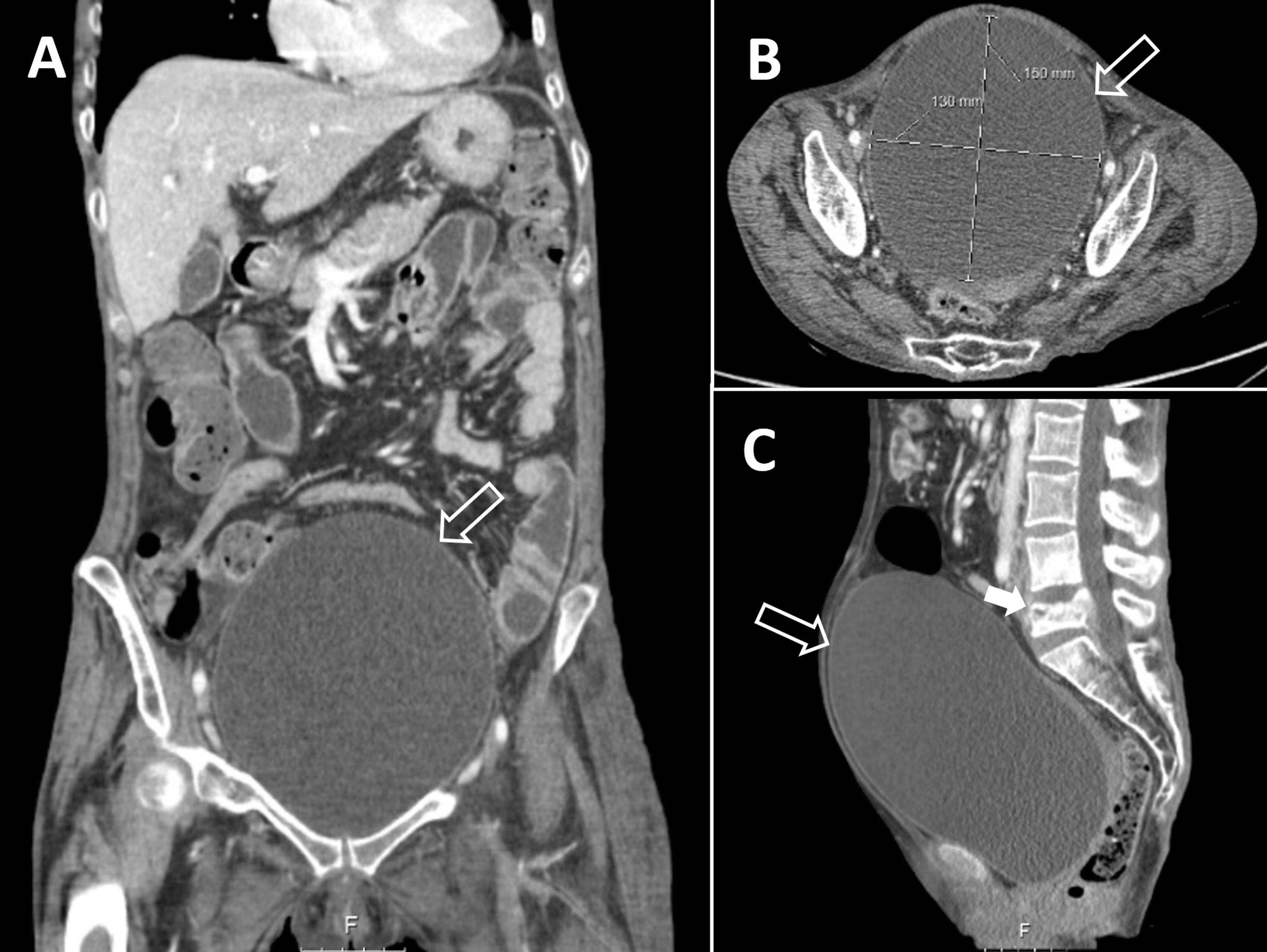 Cureus Posing as Ascites A Case Report on Neurogenic Lower Urinary