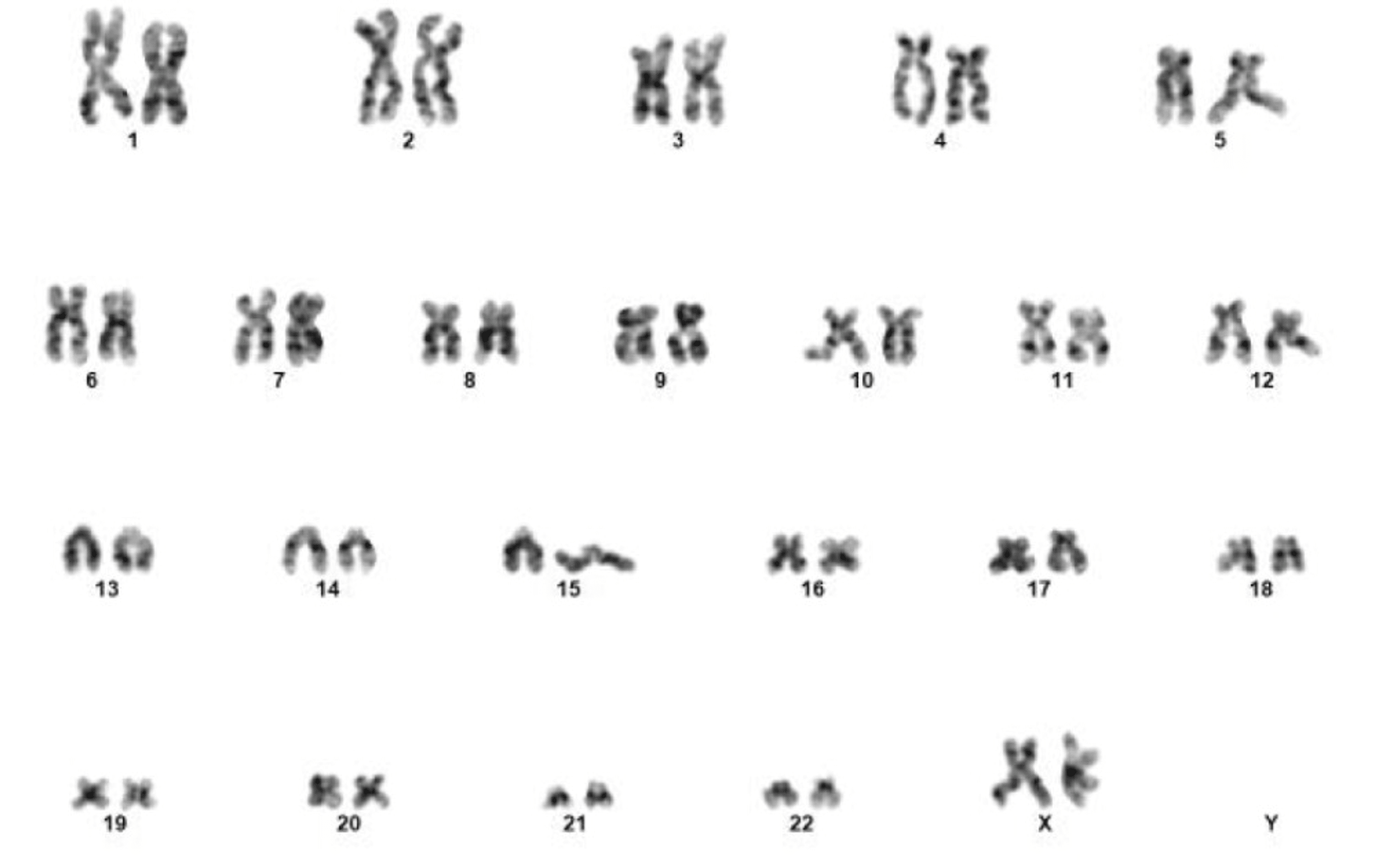 Cureus Pediatric NonDown Syndrome Acute Megakaryoblastic Leukemia With Unusual Immunophenotype