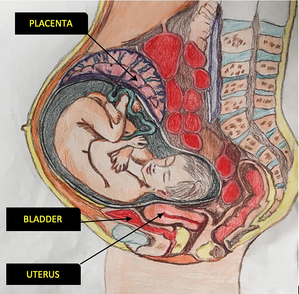 Cureus Undiagnosed Term Abdominal Pregnancy In A District Level 