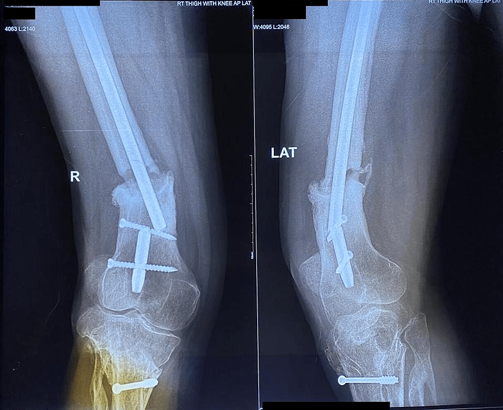 Patient with tibia nonunion. a X-ray from the pre-treatment period