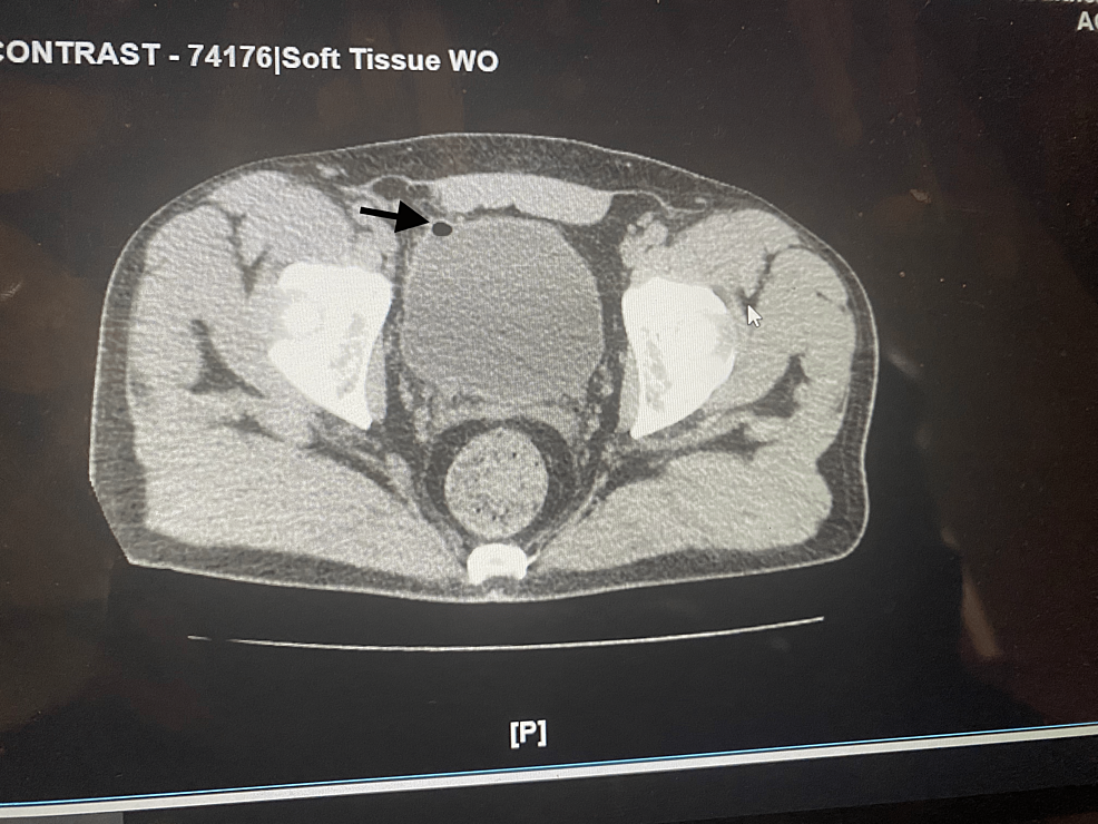 colovesical-fistula-complicating-the-first-symptomatic-episode-of-acute