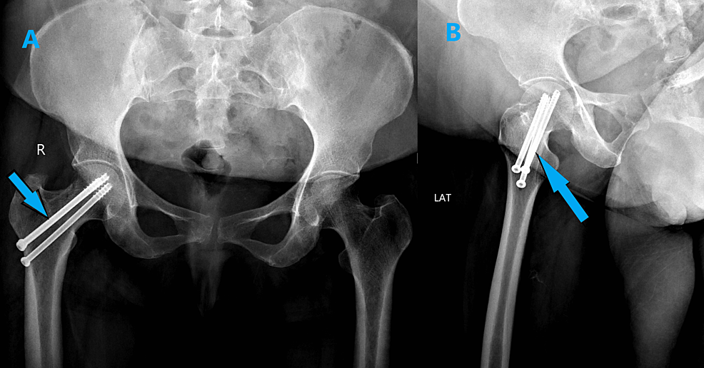 stress-fracture-of-femoral-neck-radiology-at-st-vincent-s-university