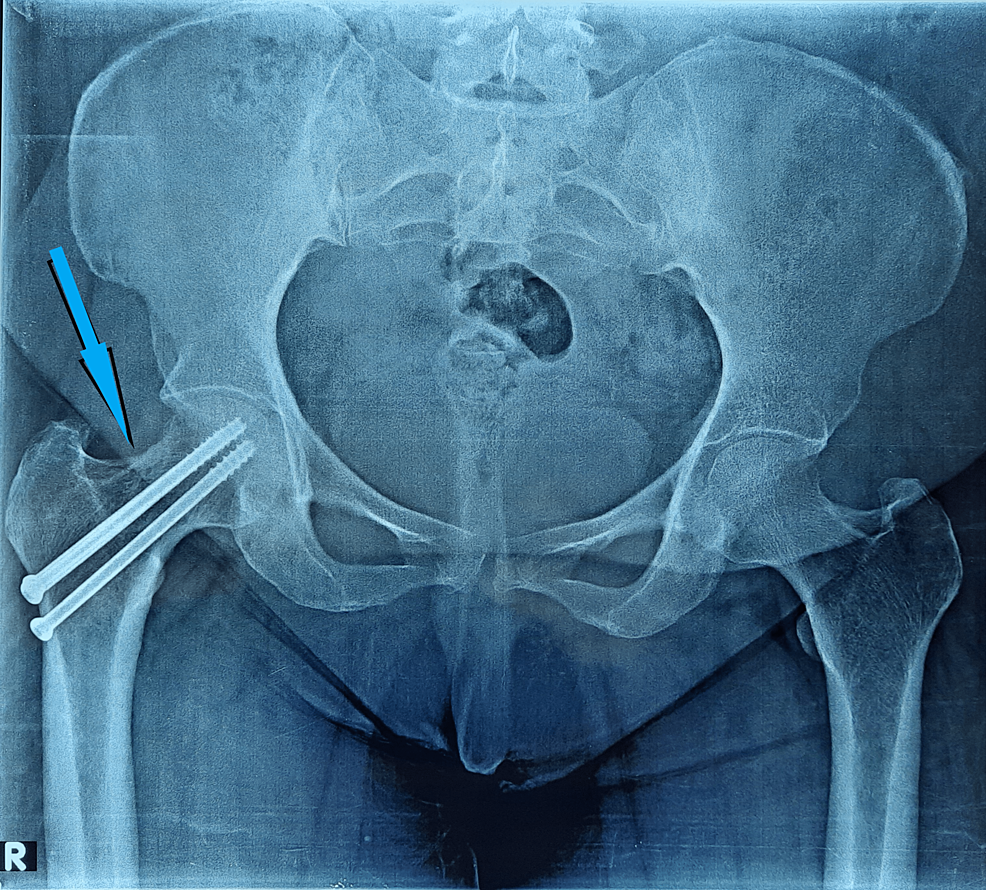 Cureus Stress Fracture Of The Femoral Neck Following Total Knee Arthroplasty A Case Series 3582