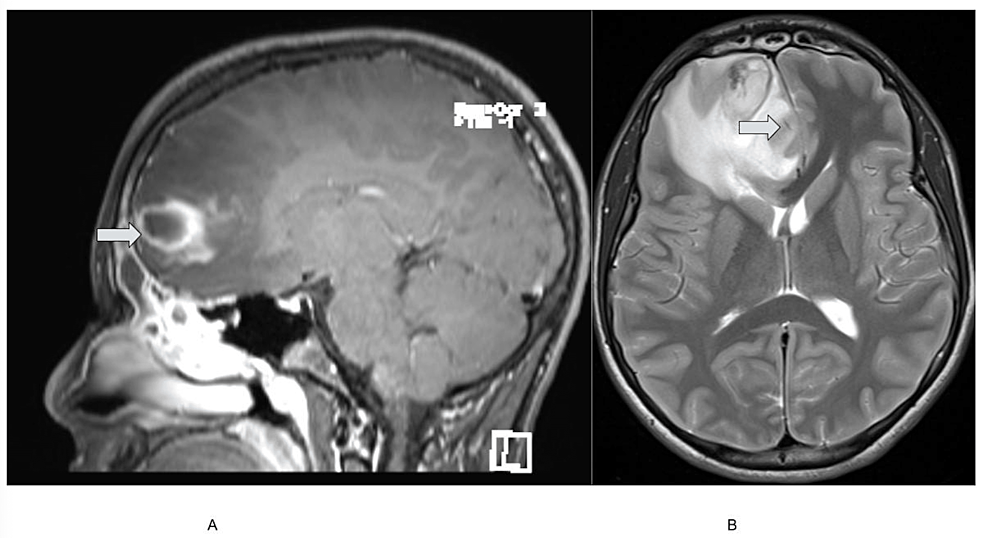 Bacterial Brain Abscess And Life-Threatening Intracranial Hypertension ...