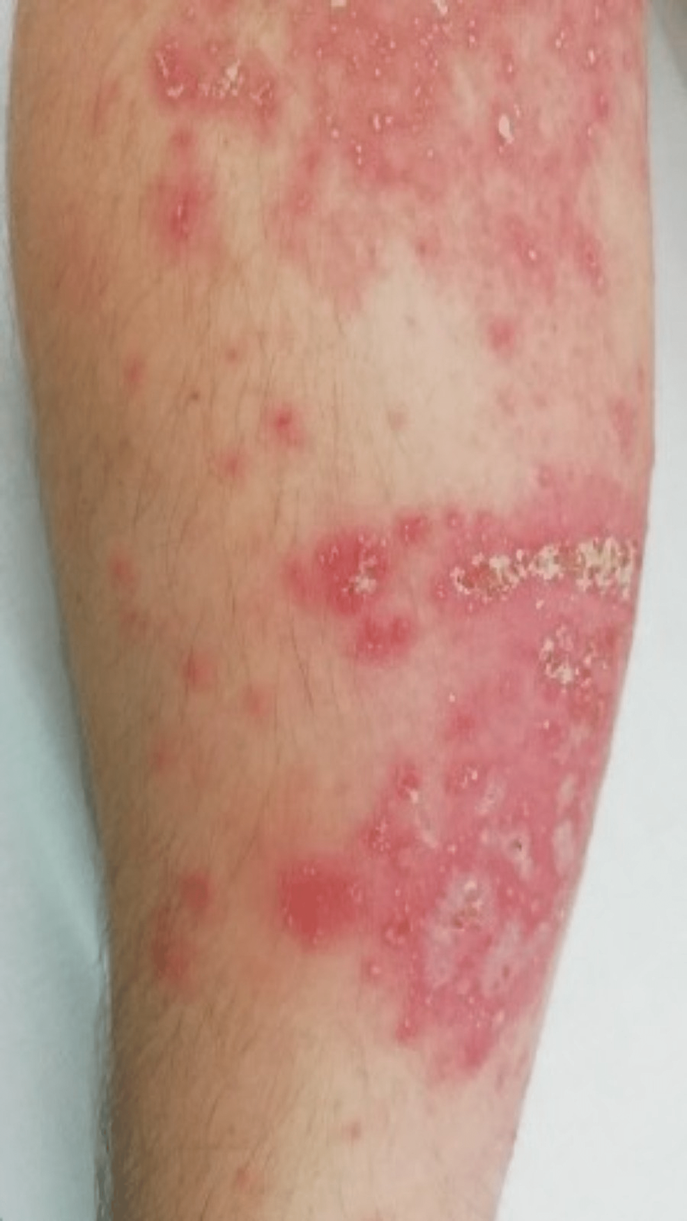 File:Neonatal Rash Groin.png - Wikimedia Commons