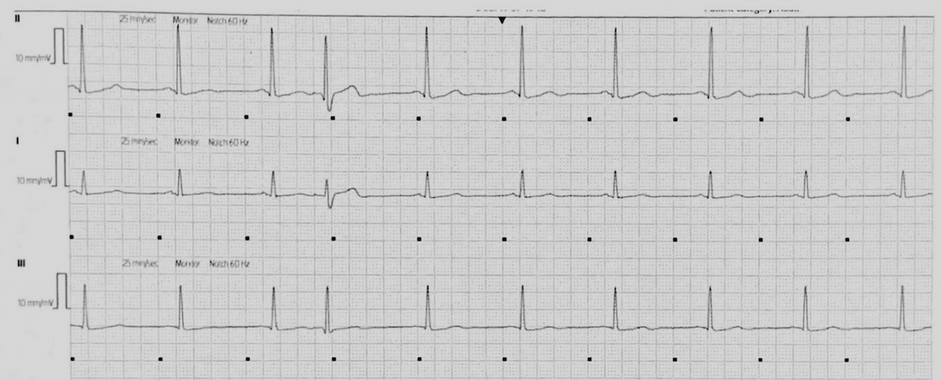 Cureus TachyBrady Syndrome in a Schizophrenic Patient A Case Report