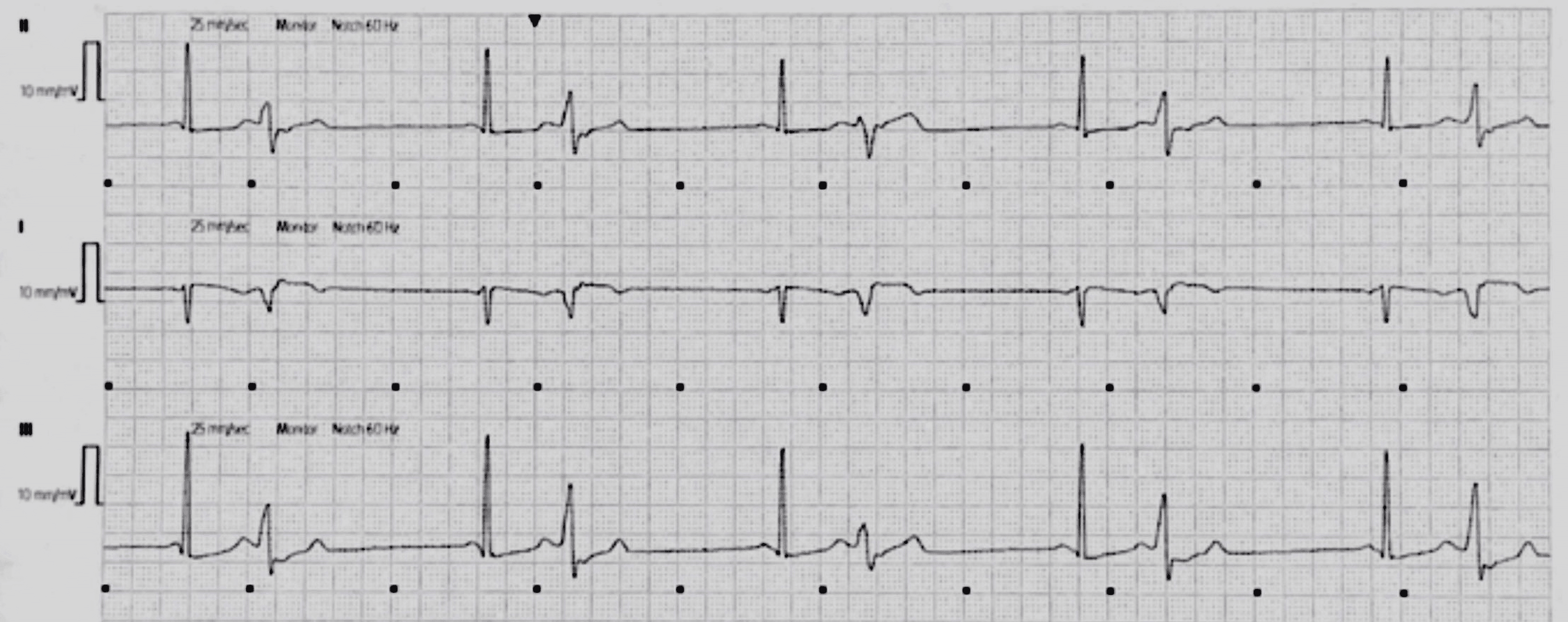 Cureus TachyBrady Syndrome in a Schizophrenic Patient A Case Report
