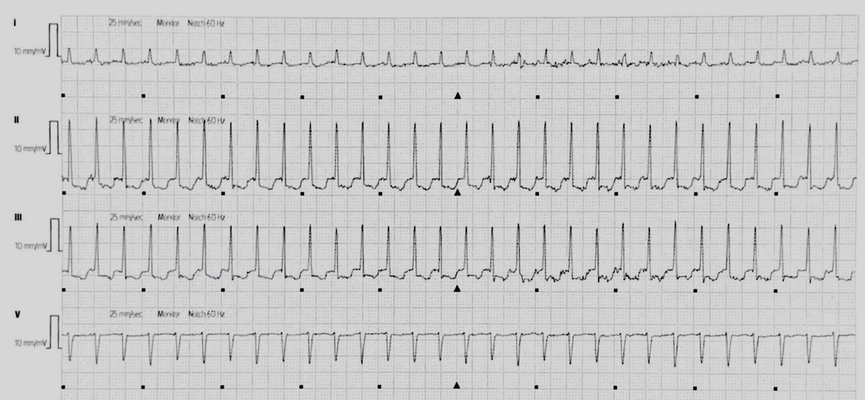 Cureus TachyBrady Syndrome in a Schizophrenic Patient A Case Report