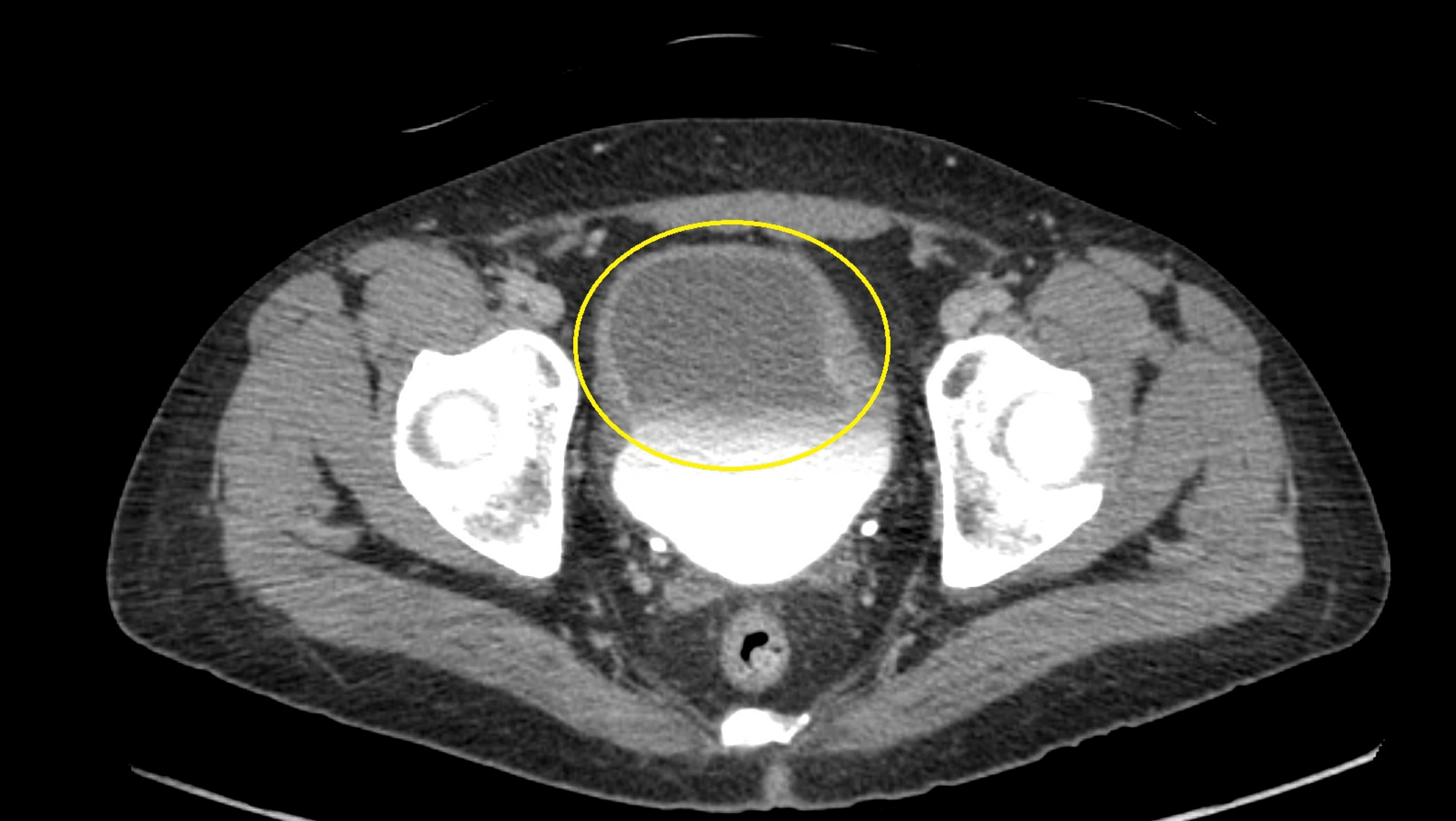 Cureus BKVirusInduced Hemorrhagic Cystitis in a Patient With Graft