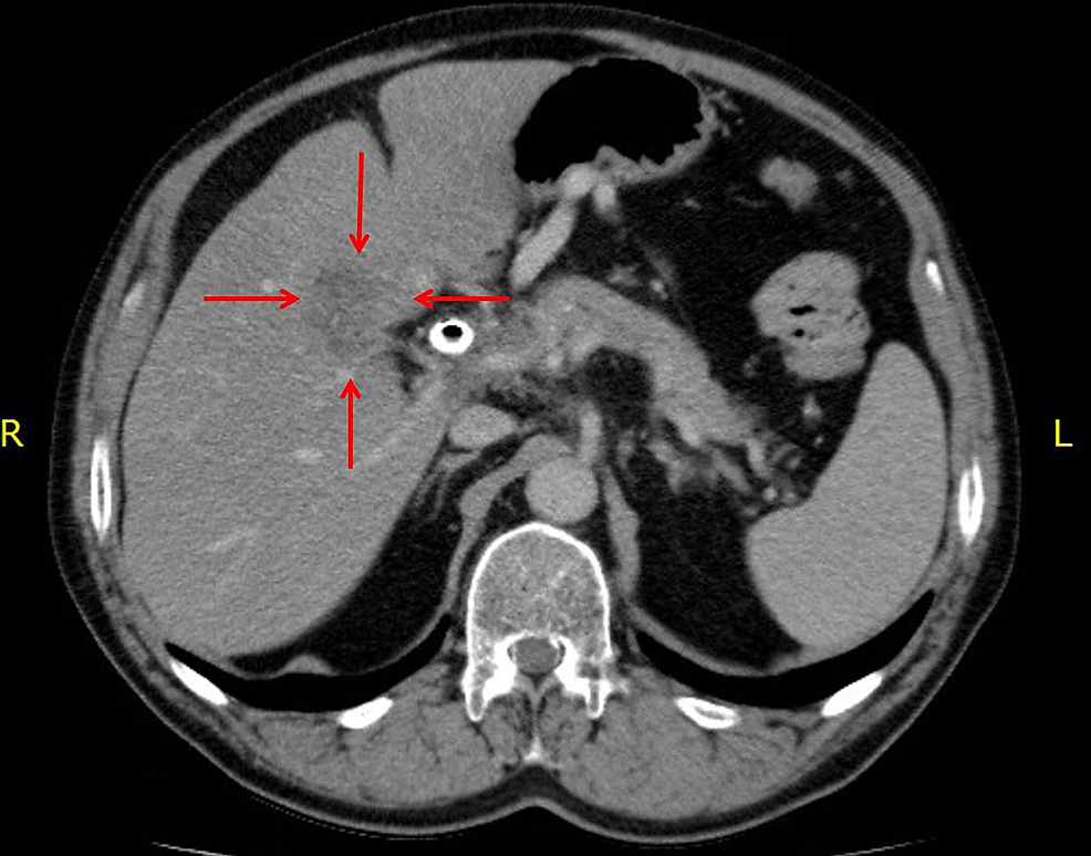 cureus-abscopal-resolution-of-a-hepatic-metastasis-in-a-patient-with