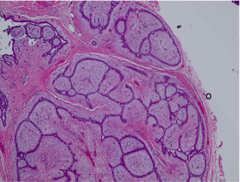 Bilateral Concurrent Benign Phyllodes Tumor In A 43 Year Old Female A 