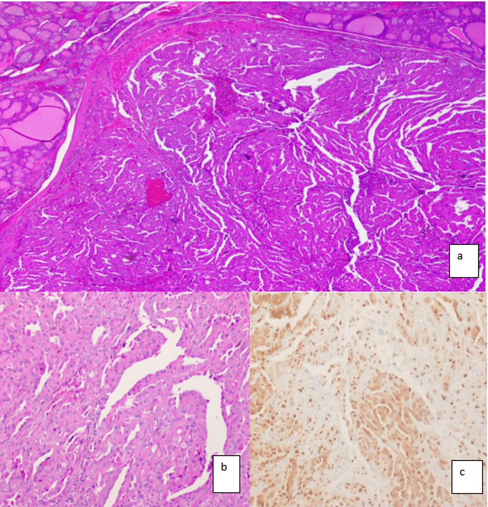 Cureus | Encapsulated Papillary Oncocytic Neoplasm: A Newly Recognized ...