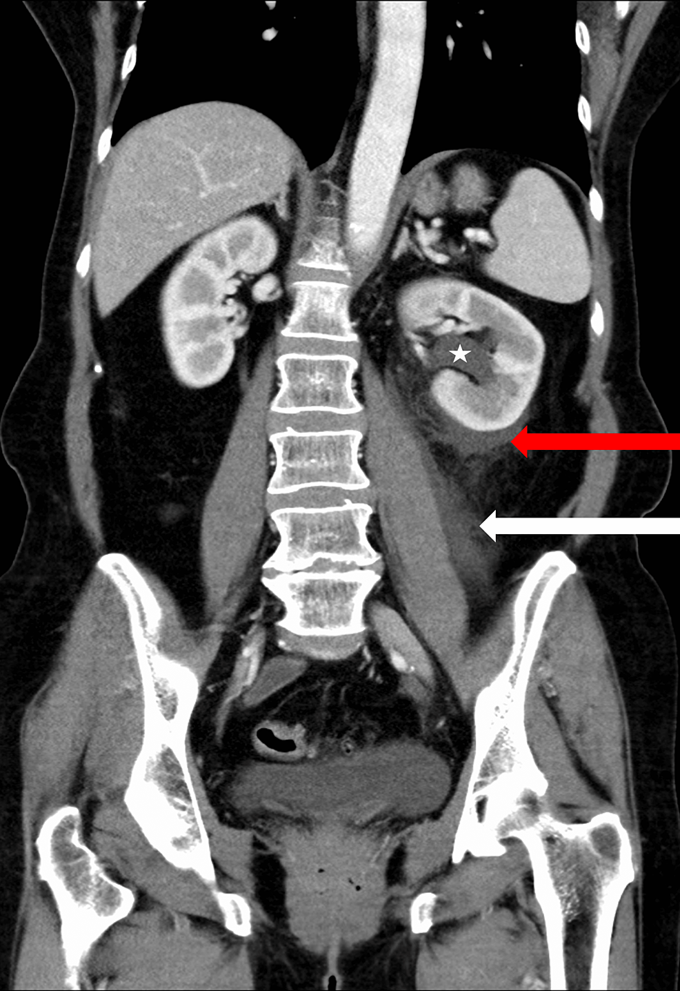 Cureus A Case of Spontaneous Ureteral Rupture Mimicking Renal Colic