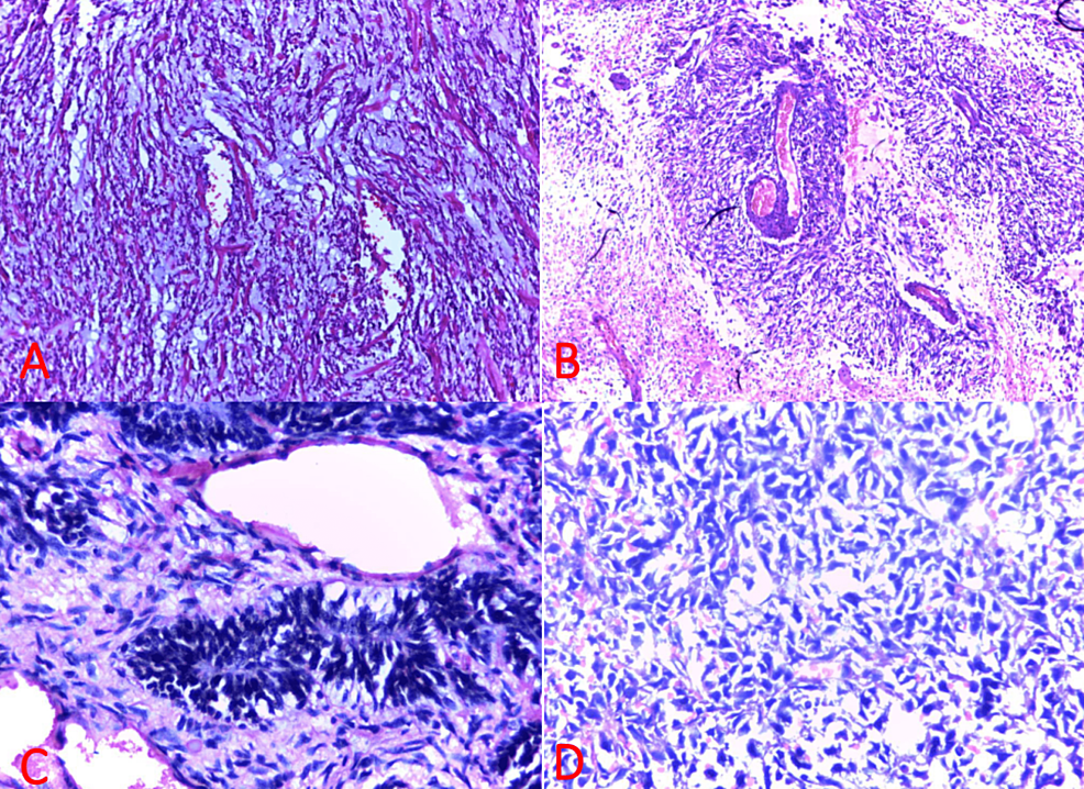 Cureus Demographic And Diagnostic Spectrum Of Neurosurgical Biopsies Initial Experience From 4804