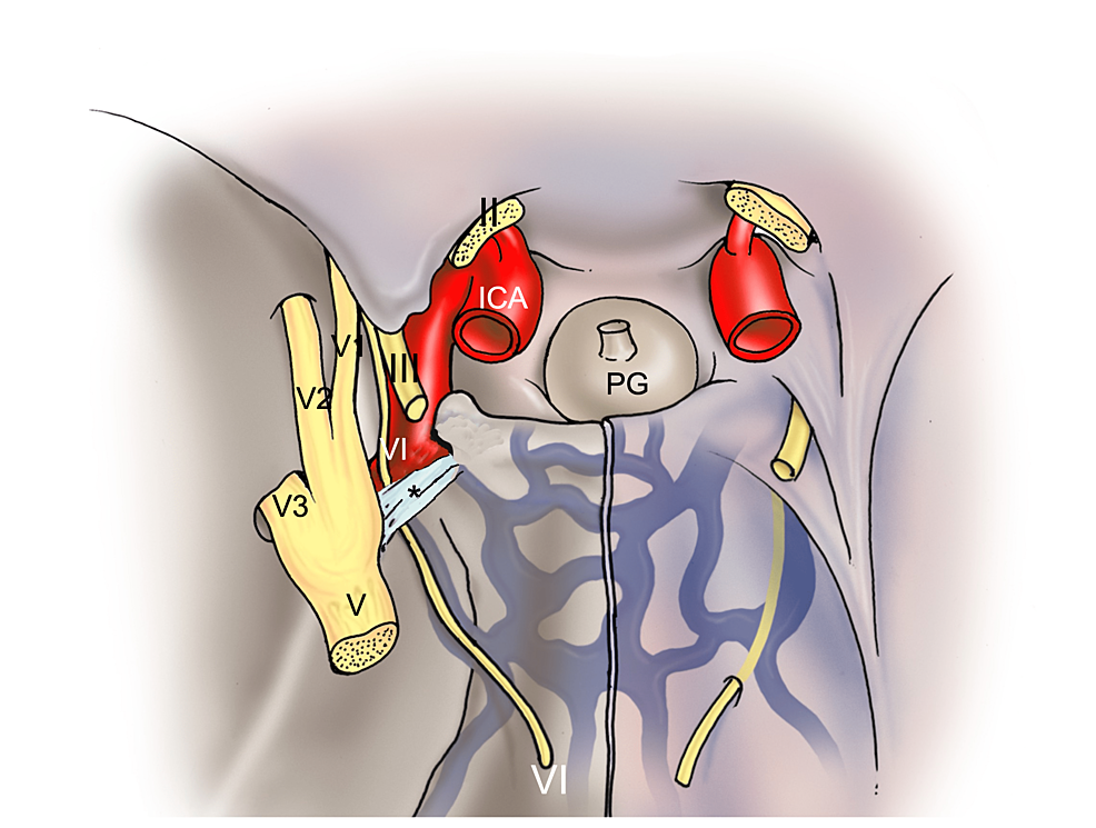 prevalence-laterality-and-classification-of-ossified-petroclival