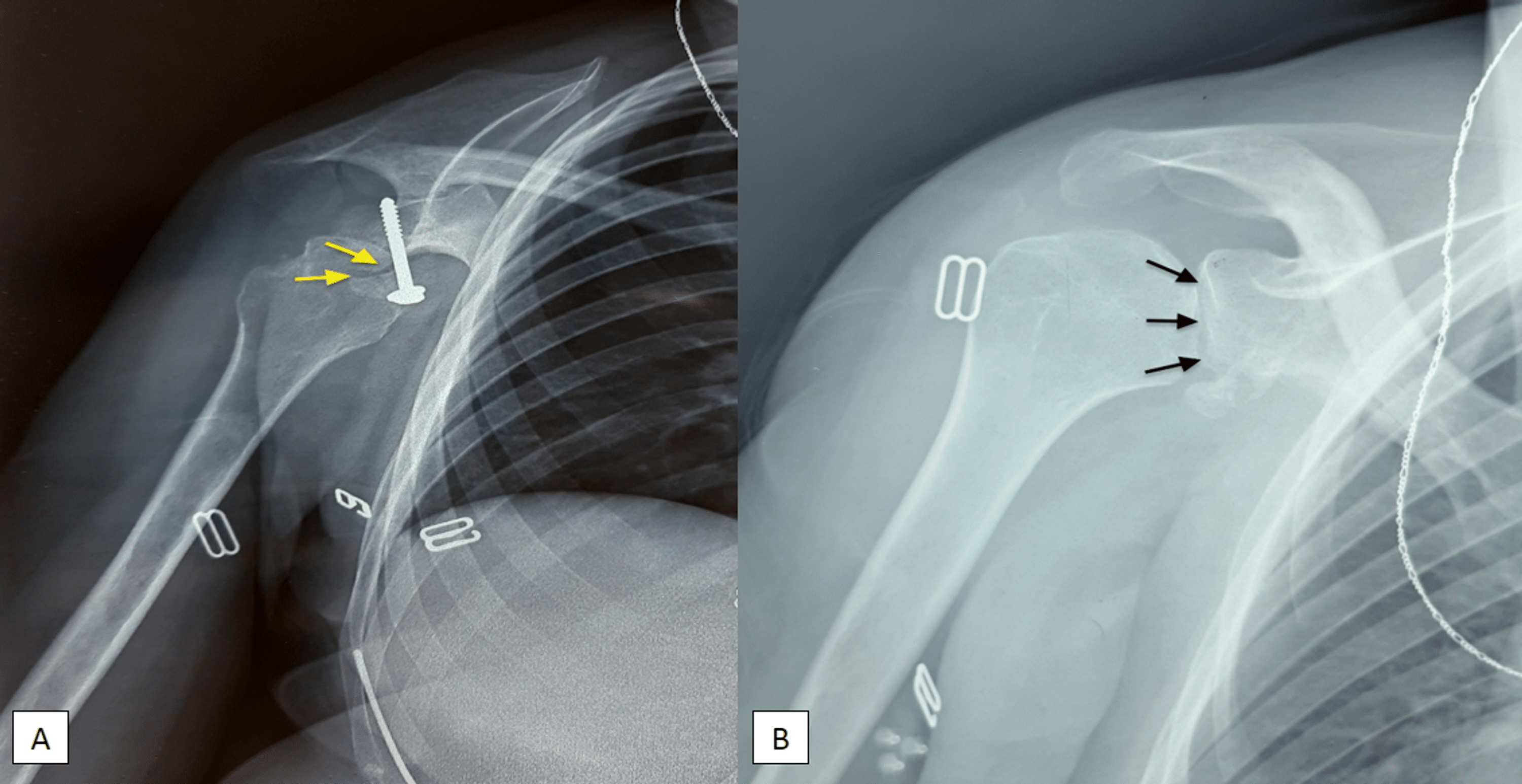 Cureus Neglected Anterior Shoulder Dislocation Treated With Open