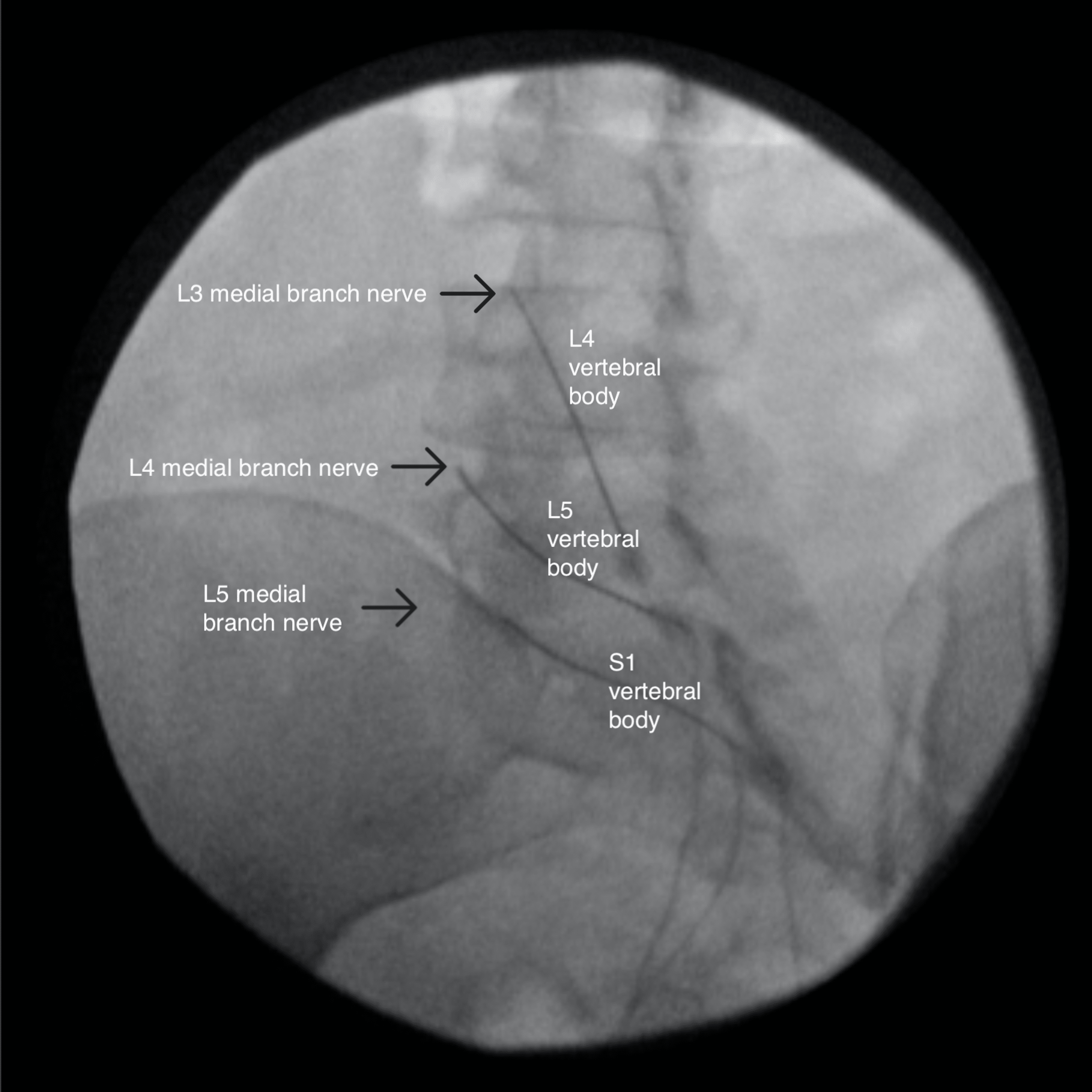 Cureus Abnormal Paresthesias Associated With Radiofrequency Ablation