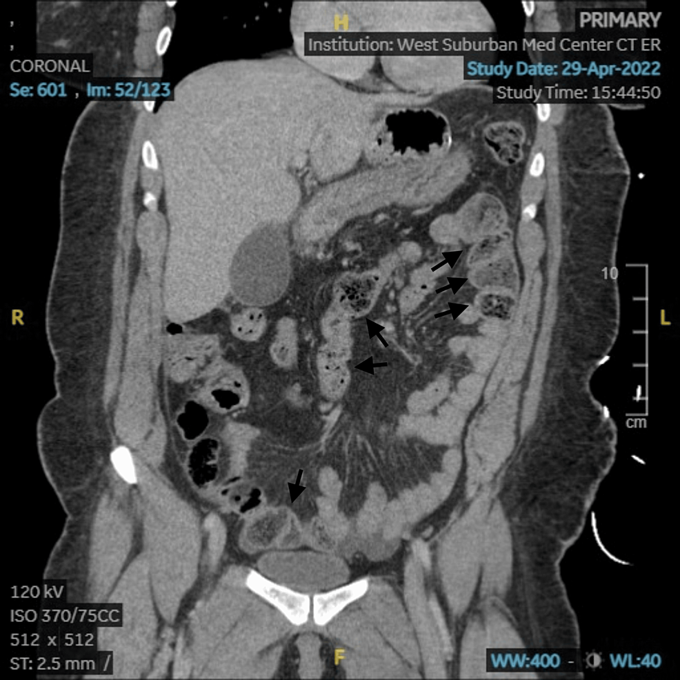 Perforated Duodenal Ulcer Post Roux En Y Gastric Bypass A Case Report Cureus